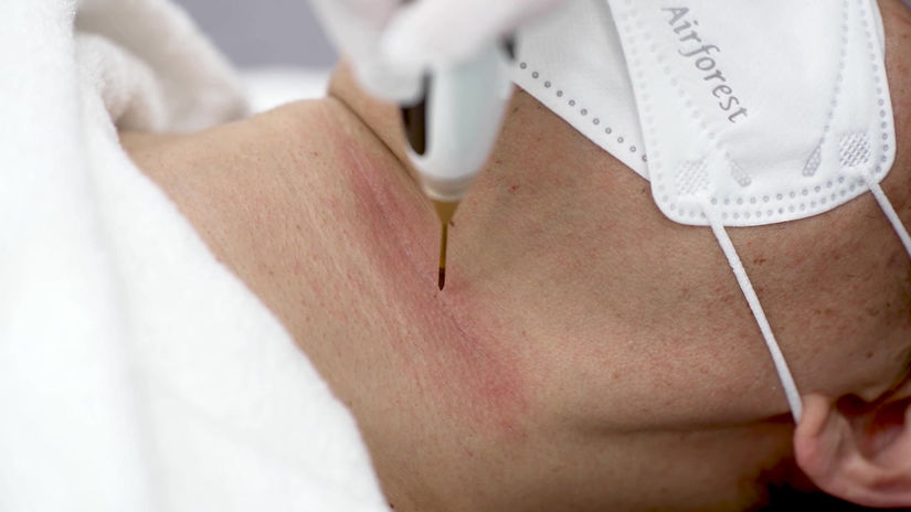 Lifting plasma